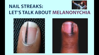 Streaks in Your Nails Lets Talk about Melanonychia Well Also Look at Skin Tags amp Skin Polyps [upl. by Anatola]