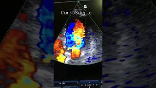 CardioScienceEcocardiograma Doppler Color insuficiencia Aortica [upl. by Ydissahc]