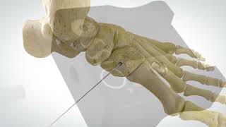 OSSIOfiber® Threaded Trimmable Fixation Nail  Lisfranc Technique [upl. by Birck]