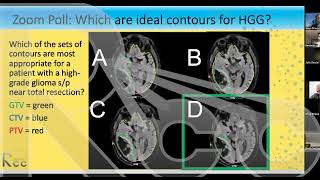 Session 9 CNS High Grade Glioma Hypofractionation [upl. by Ahsiei]