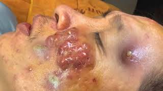 Big Cystic Acne Blackheads Extraction Blackheads amp Milia Whiteheads Removal Pimple Popping 0239 [upl. by Alistair]