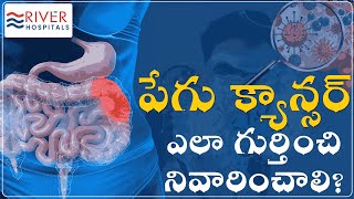 Cancer  Reasons for intestine cancer  intestine cancer  intestine cancer treatment [upl. by Haianeb]