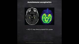 Autoimmune Encephalitis Radiological imaging [upl. by Anyd]