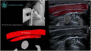 Sonographische Darstellung der seitlichen Nackenmuskeln [upl. by Laehcym]