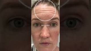 Using A FasciaBlaster On Your Face  Before amp After [upl. by Yrrac]