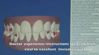 Invisalign ClinCheck Explanation [upl. by Gnurt]