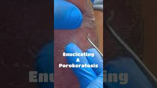 Enucleating A Porokeratosis [upl. by Doownyl689]