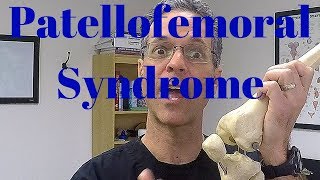 Chondromalacia Patella AKA Patellofemoral Syndrome [upl. by Savitt886]