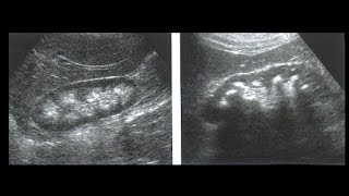 Medullary Nephrocalcinisis  Milk of Calcium  Kidney Disease  Renal Stone [upl. by Aysahc]