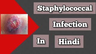 Staphylococcal infection in hindi  Pathology in hindi  Staphylococcus aureus  pathology lecture [upl. by Eecyac758]