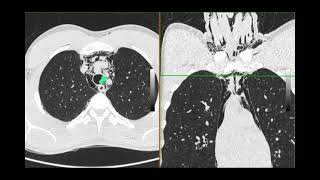 Pneumomediastinum [upl. by Atalie]