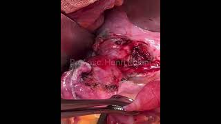 Presacral Pelvic Tumor Advancing in the IschioRectal Space [upl. by Glimp743]