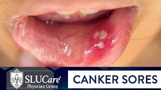 Determining Causes amp Treatment for Canker Sores  SLUCare Otolaryngology [upl. by Nyladnohr]