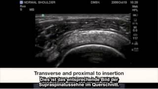 Fallstudie FujiFilm SonoSite Pathologie der Supraspinatussehne [upl. by Reffinnej302]