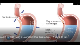 Living a Normal Life Post Gastrectomy [upl. by Raddy]