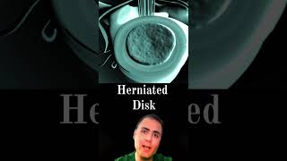 Herniated Disc  usmle Review [upl. by Suollecram]