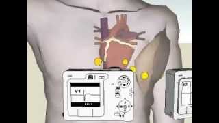 Posicion de derivaciones ECG [upl. by Aikemaj607]