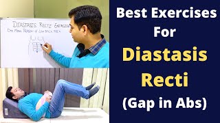 Exercises For Diastasis Recti Abdominal Seperation Diastasis Recti Treatment Reason of Back Pain [upl. by Nosnevets]