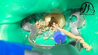 How To Remove GuttaPercha Easily During Root Canal Retreatment Cases  Easy GuttaPercha Removal [upl. by Danita]