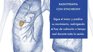 Radioterapia con Synchrony y cáncer de pulmón [upl. by Quint]