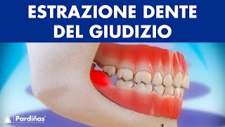 Estrazione dente del giudizio e pericoronarite © [upl. by Maggie513]