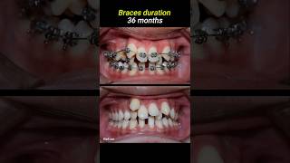 Braces for crowded teeth braces orthodontist dentistry dentist [upl. by Notliw]