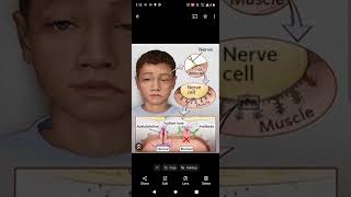 Myasthenia gravis causes symptoms pathology neuromuscular neetmedicos auto immune disorder [upl. by Nanahs470]