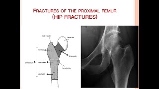 Fracture of Proximal Femur [upl. by Liddie604]