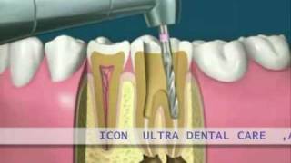 root canal treatment demo [upl. by Mommy]