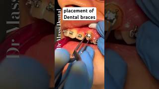 Placement of Dental BRACES Orthodontics [upl. by Asyram]