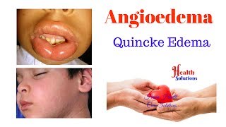 Angioedema  Quincke Edema [upl. by Angie]