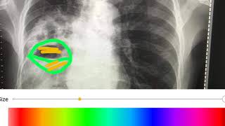 រៀនមេីលហ្វីល Rx pulmonary ថតសួត របេងសួត [upl. by Lannie998]