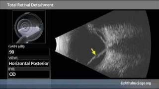 Total Retinal Detachment [upl. by Tdnarb]