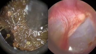 173  Ear Wax Removal In Bruised Ear Stained with Blood due to Cotton Swab Misuse with the WAXscope [upl. by Aggi]