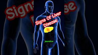 Liver Disease Warning Signs  Liver Disease Symptoms  Liver Damage  Acute Liver Failure [upl. by Rachelle]