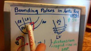 Bounding Pulses in Aortic Regurgitation [upl. by Oivat325]