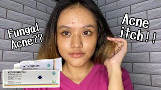 I tried to use ketoconazole cream for my small acne⎮English⎮66 [upl. by Rubi]