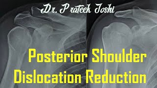 Posterior Shoulder Dislocation Reduction  Dr Prateek Joshi [upl. by Caressa]