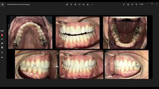 Adult Unilateral Posterior Crossbite  Clearly Aligners [upl. by Alyahc633]