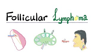 Follicular Lymphoma  Indolent BCell Lymphoma  NonHodgkin’s Lymphoma  Hematology [upl. by Rozek]