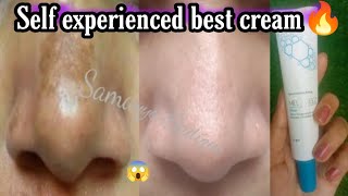 Self experienced best cream for melasma  melaneez cream review [upl. by Dani]