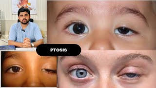 Ptosis and its classification drhashimjabbar education optometry eye ptosis [upl. by Grange]