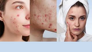 7 Remedies for Acne  Home Remedies  Pimple  Acne  Remove Acne Marks  viral trendingAnaysa [upl. by Kiley]