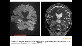 74 Postictal imaging changes excitotoxic edema hyperperfusion BBB disruption seizure related [upl. by Madanhoj]