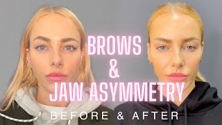 Asymmetrical Brows Fix Dr Nina Bals Solution for Asymmetrical Brows amp Jawline with Fae Williams [upl. by Dorcy269]