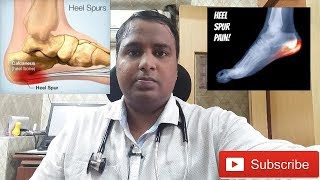 HEEL PAINCALCANEAL SPUR TREATMENTएड़ी के दर्द का इलाज [upl. by Us114]