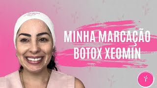 Minha marcação para Toxina Xeomin  Dias de Maricota [upl. by Egreog]