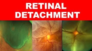 Retinal Detachment Types Risk Factors Pathophysiology Symptoms and Signs [upl. by Dianne]