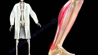 Achilles Tendon Stress amp Strain  Everything You Need To Know  Dr Nabil Ebraheim [upl. by Lamaaj]