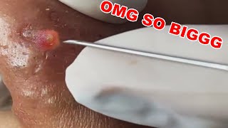 Nose Blackheads Extracted [upl. by Darrill598]